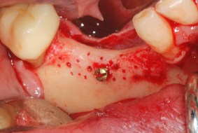 Sella edentula intercalata con vite Profix® di sostegno membrana