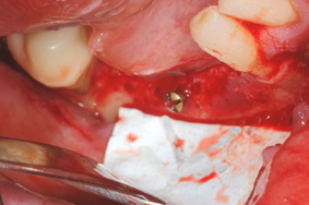 Posizionamento delle membrana in PTFE Cytoplast con rinforzo in titanio