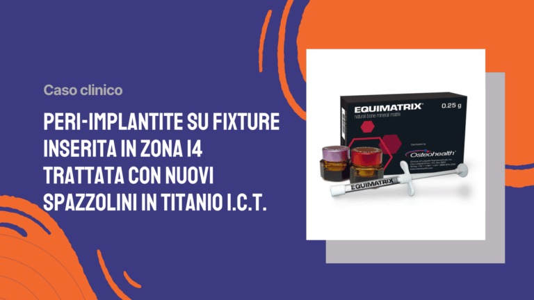 Peri-implantite su fixture inserita in zona 14 trattata con nuovi spazzolini in titanio I.C.T.