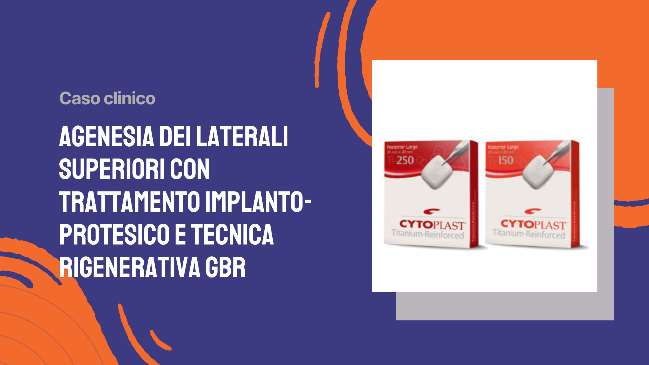 Agenesia dei laterali superiori con trattamento implanto-protesico e tecnica rigenerativa GBR