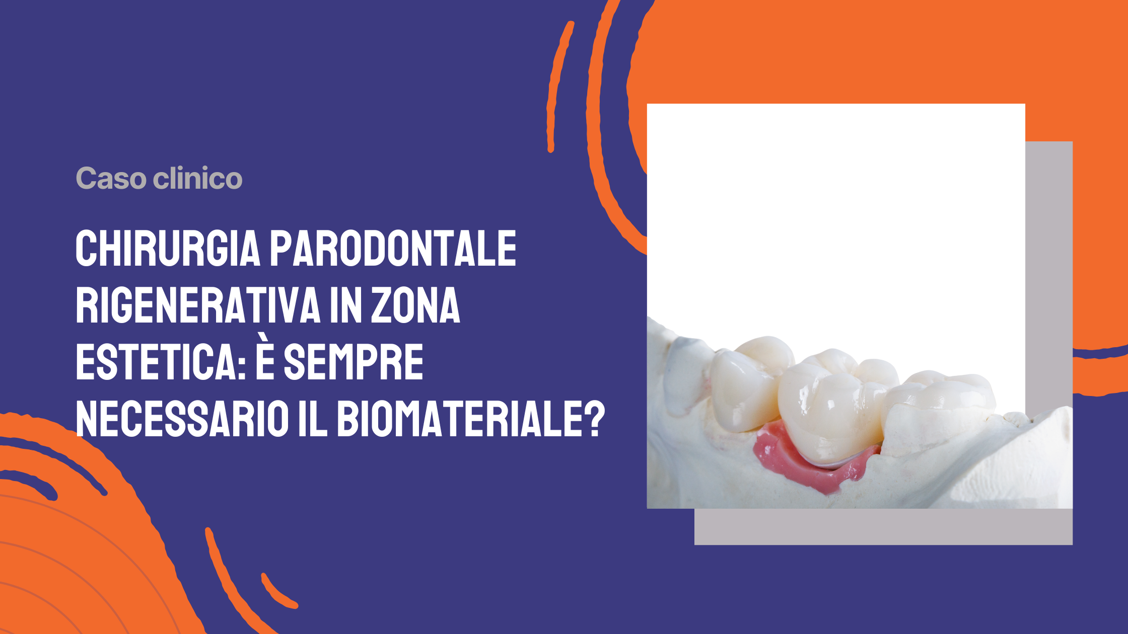 Chirurgia parodontale rigenerativa in zona estetica è sempre necessario il biomateriale