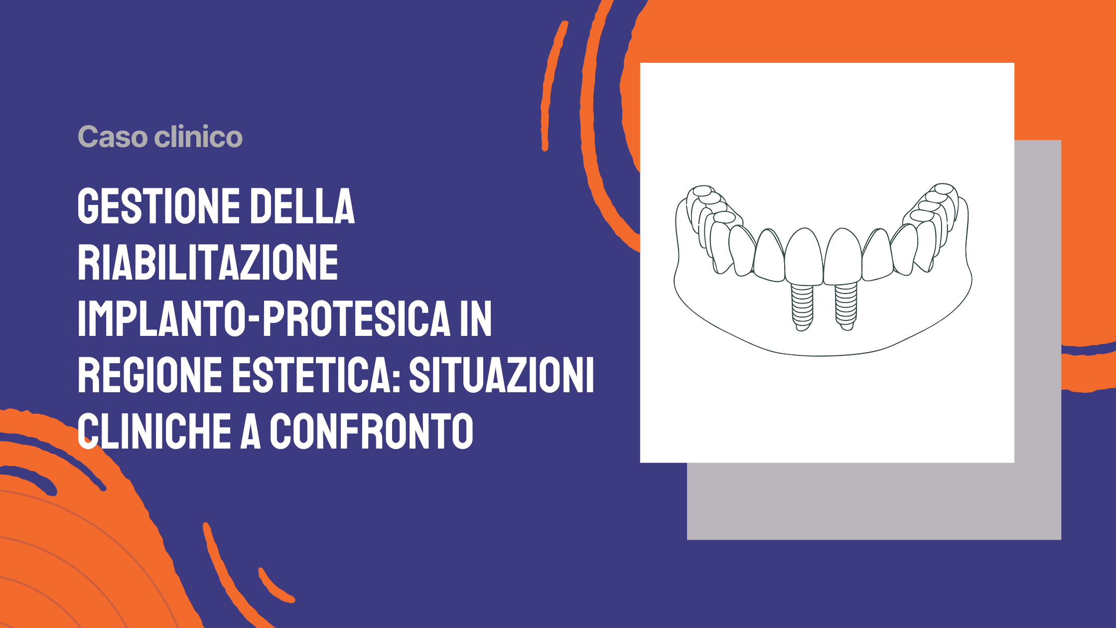 Gestione della riabilitazione implanto-protesica in regione estetica situazioni cliniche a confronto