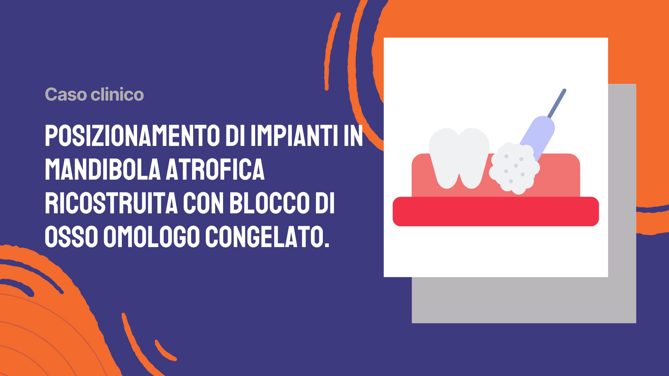 Posizionamento di impianti in mandibola atrofica ricostruita con blocco di osso omologo congelato.