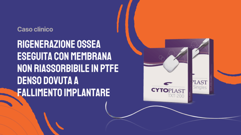 Rigenerazione ossea eseguita con membrana non riassorbibile in PTFE denso dovuta a fallimento implantare