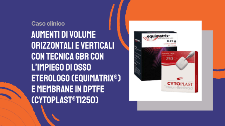 Aumenti di volume orizzontali e verticali con tecnica GBR con l’impiego di osso eterologo (Equimatrix®) e membrane in dPTFE (Cytoplast®Ti250)