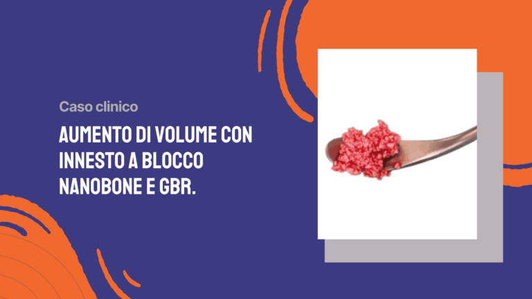 Aumento di volume con innesto a blocco NanoBone e GBR.