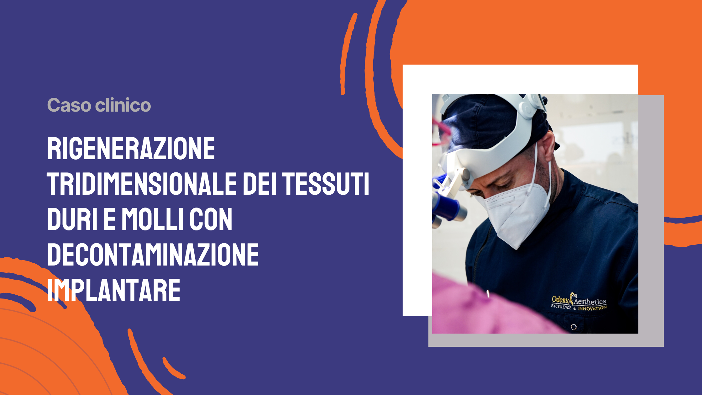 Aumento orizzontale di cresta atrofica eseguito con utilizzo di membrana in PTFE rinforzata in titanio (1)