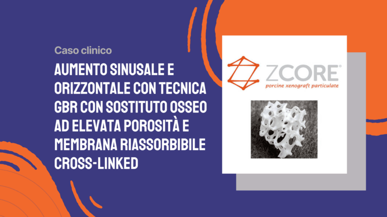 Aumento sinusale e orizzontale con tecnica GBR con sostituto osseo ad elevata porosità e membrana riassorbibile cross-linked