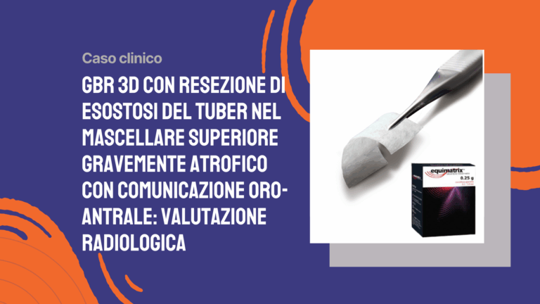 GBR 3D con resezione di esostosi del tuber nel mascellare superiore gravemente atrofico con comunicazione oro-antrale: valutazione radiologica