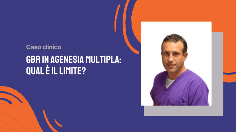 GBR in agenesia multipla: qual è il limite?