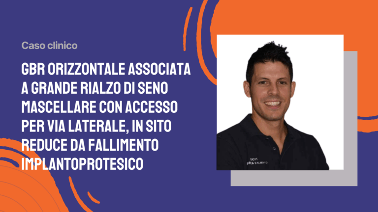 GBR orizzontale associata a grande rialzo di seno mascellare con accesso per via laterale, in sito reduce da fallimento implantoprotesico