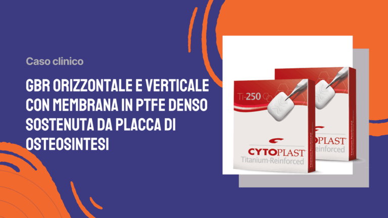 GBR orizzontale e verticale con membrana in ptfe denso sostenuta da placca di osteosintesi