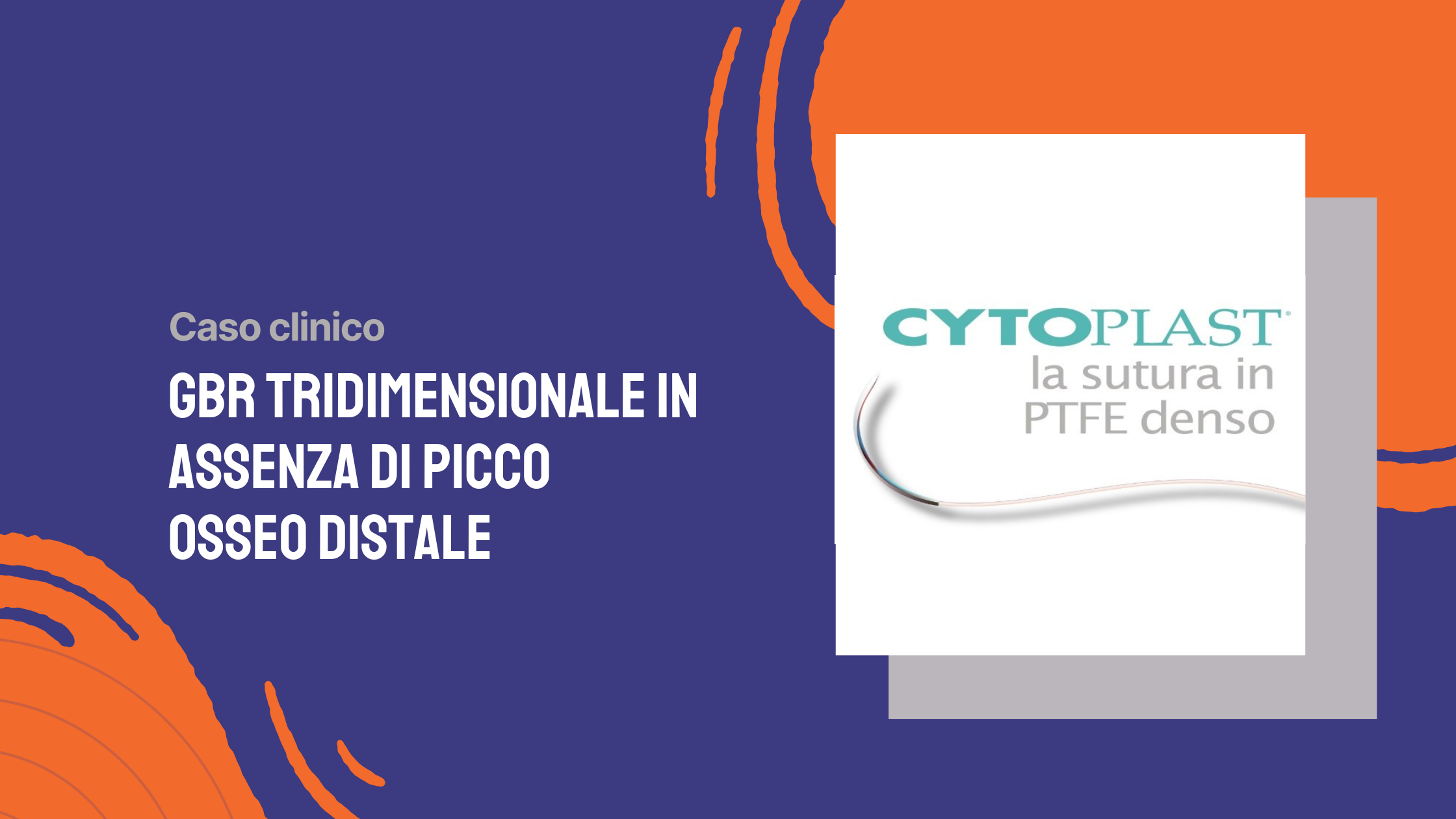 GBR tridimensionale in assenza di picco osseo distale