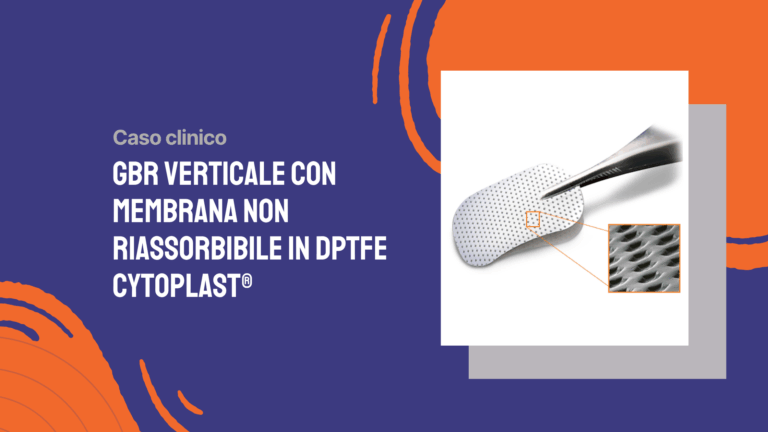 GBR verticale con membrana non riassorbibile in dPTFE Cytoplast®