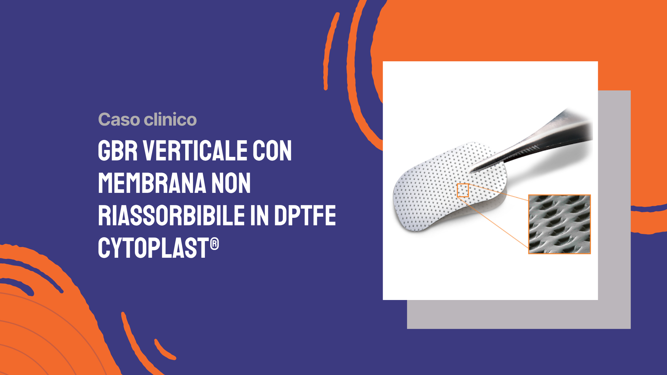 GBR verticale con membrana non riassorbibile in dPTFE Cytoplast®