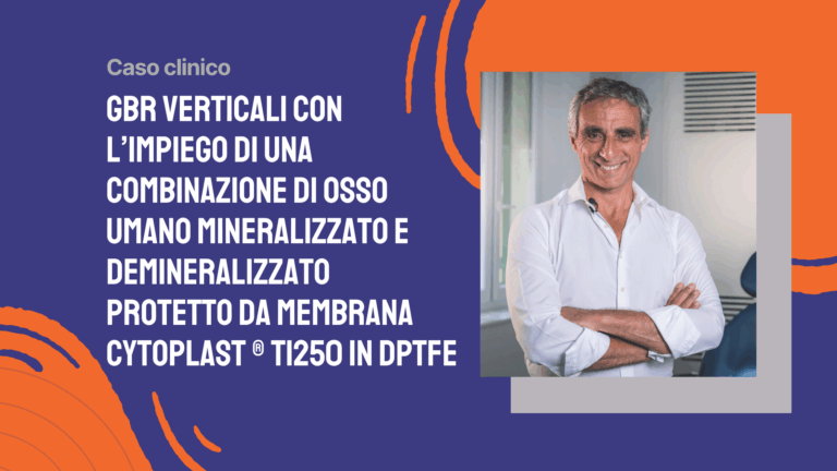 GBR verticali con l’impiego di una combinazione di osso umano mineralizzato e demineralizzato(enCore® Combination Allograft) protetto da membrana Cytoplast ® Ti250 in dPTFE