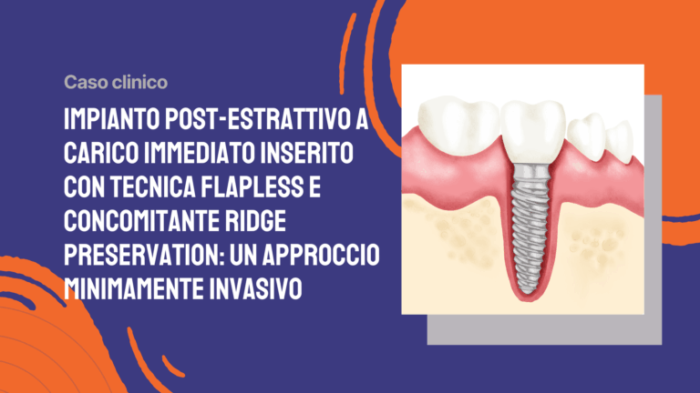 Impianto post-estrattivo a carico immediato inserito con tecnica flapless e concomitante ridge preservation: un approccio minimamente invasivo