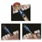 NovaBone sostituto osseo di sintesi