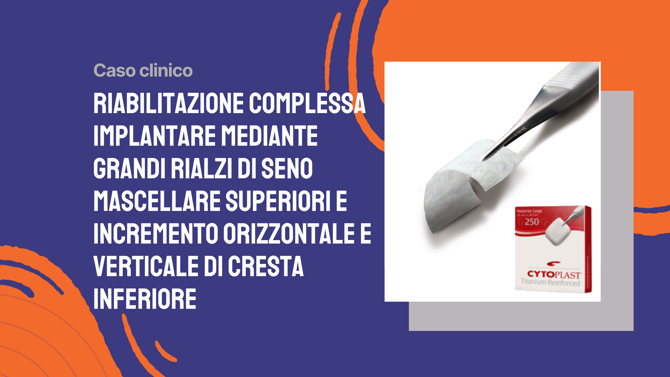 Riabilitazione complessa implantare mediante grandi rialzi di seno mascellare superiori e incremento orizzontale e verticale di cresta inferiore