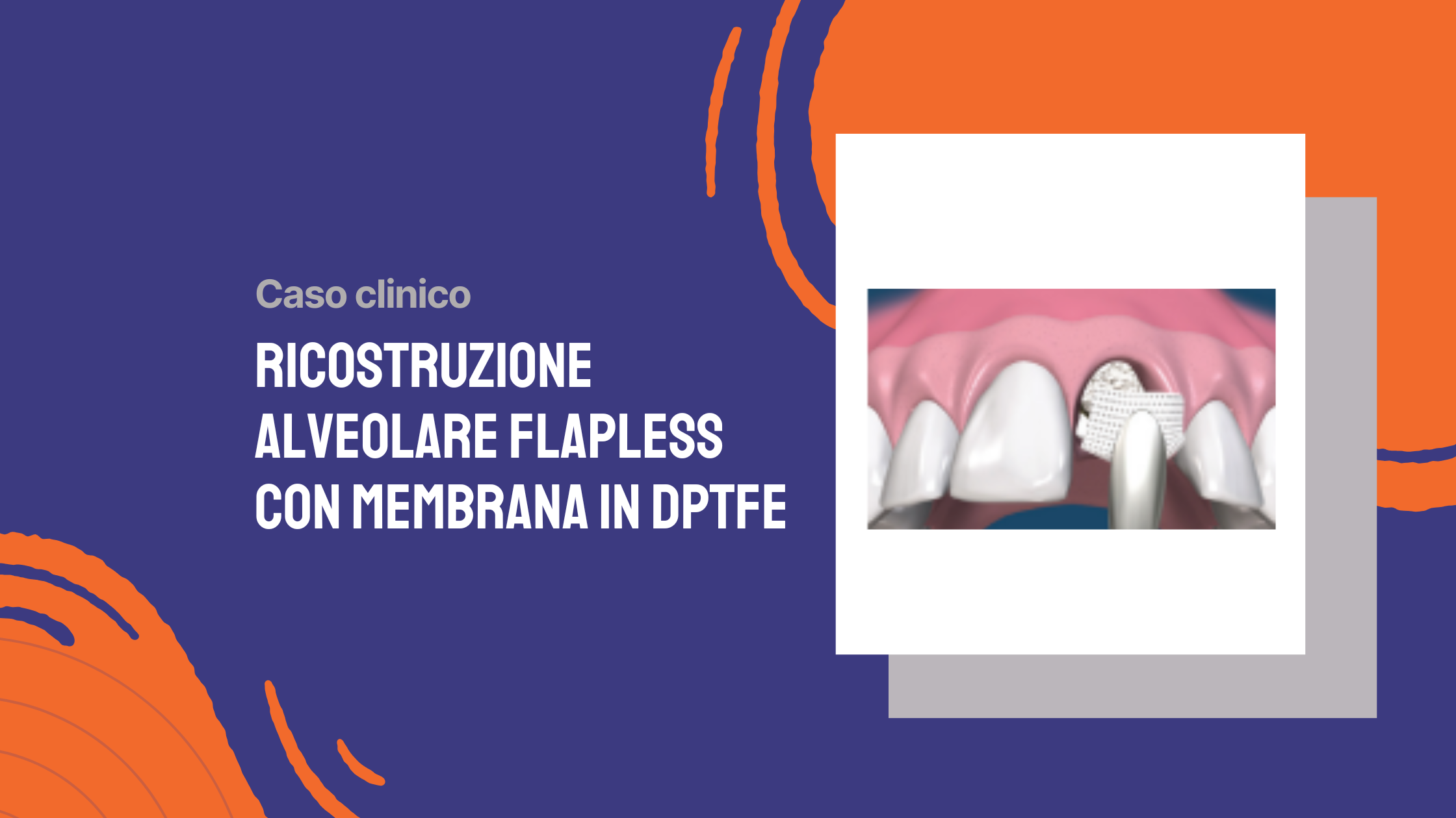 Ricostruzione alveolare flapless con membrana in dPTFE