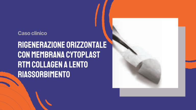 Rigenerazione Orizzontale con membrana Cytoplast RTM Collagen a lento riassorbimento