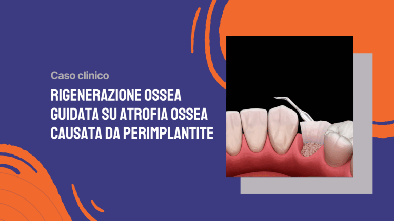 Rigenerazione ossea guidata su atrofia ossea causata da perimplantite