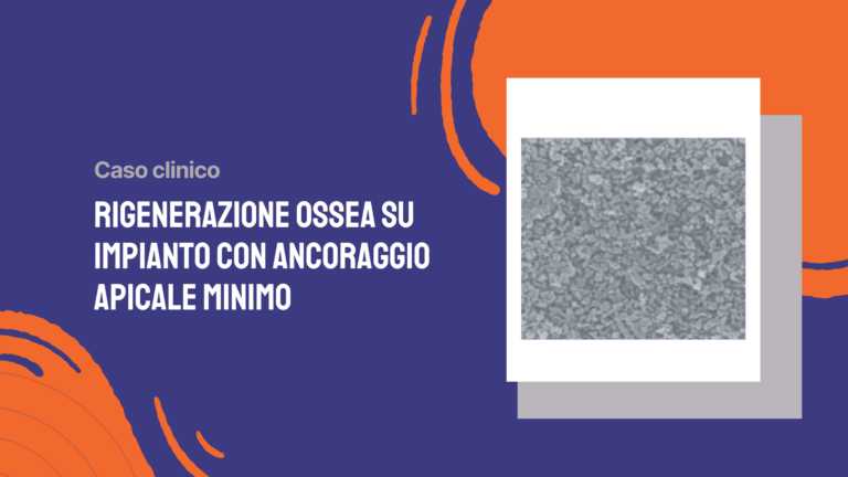 Rigenerazione ossea su impianto con ancoraggio apicale minimo