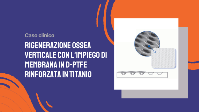 Rigenerazione ossea verticale con l’impiego di membrana in d-PTFE rinforzata in titanio