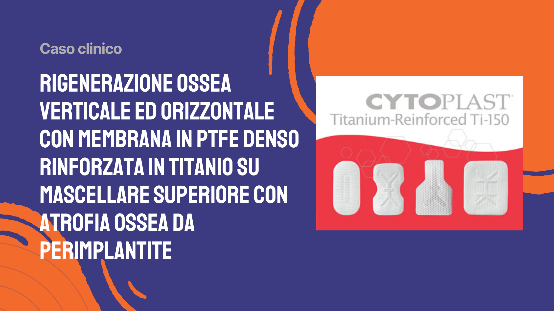 Rigenerazione ossea verticale ed orizzontale