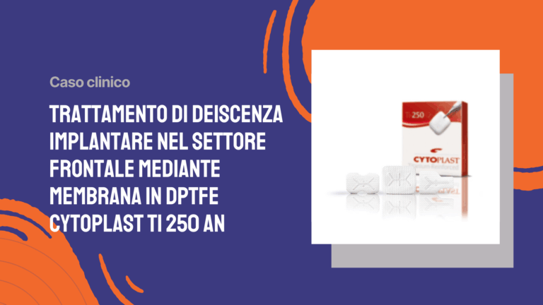 Trattamento di deiscenza implantare nel settore frontale mediante membrana in dPTFE Cytoplast Ti 250 AN