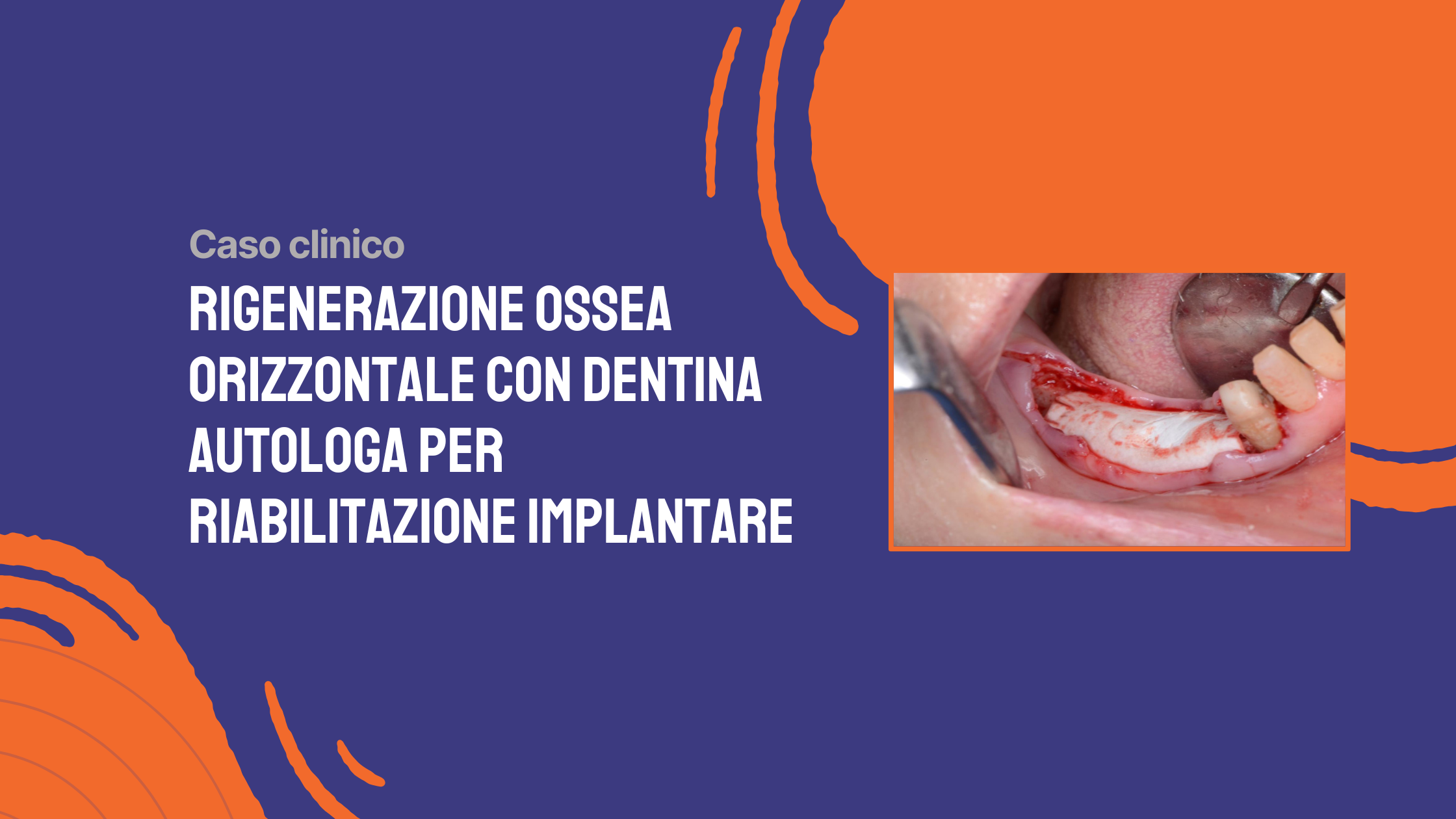 Rigenerazione ossea orizzontale con dentina autologa per riabilitazione implantare