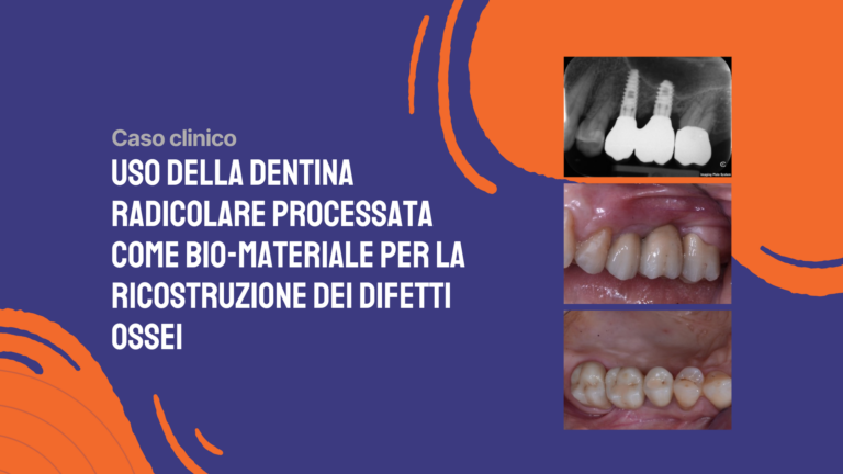 Uso della dentina radicolare processata come bio-materiale per la ricostruzione dei difetti ossei