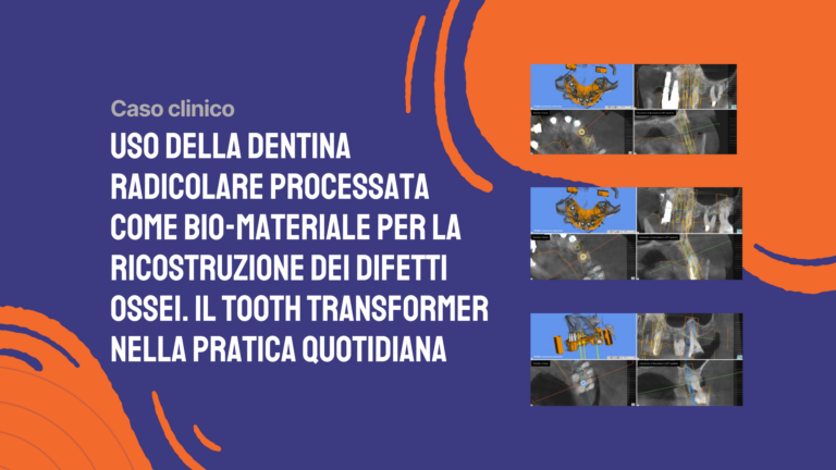 Uso della dentina radicolare processata come bio-materiale per la ricostruzione dei difetti ossei. Il Tooth Transformer nella pratica quotidiana