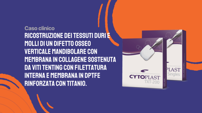 Ricostruzione dei tessuti duri e molli di un difetto osseo verticale mandibolare con membrana in collagene sostenuta da viti tenting con filettatura interna e membrana in dPTFE rinforzata con titanio.