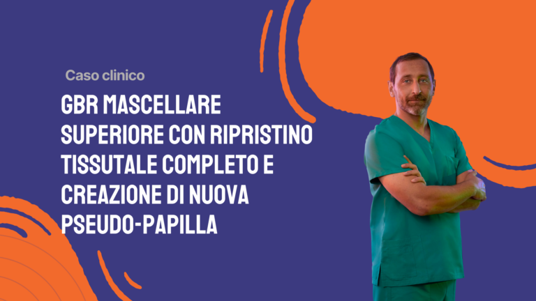 GBR mascellare superiore con ripristino tissutale completo e creazione di nuova pseudo-papilla.